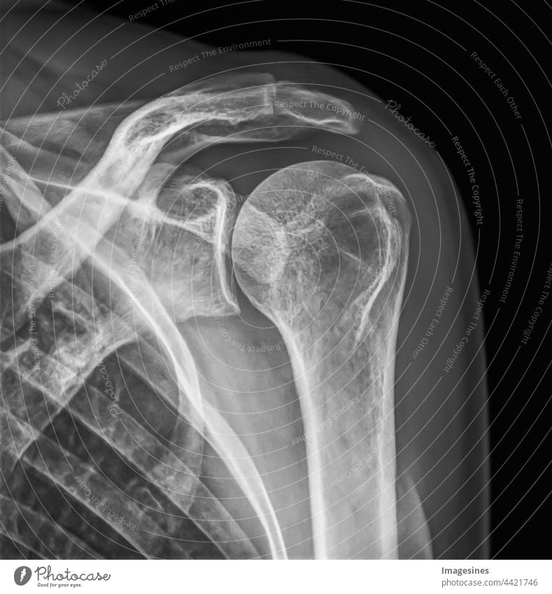 Röntgenbild eines weiblichen gesunden Körpers. Röntgenbild der weiblichen Schulter auf schwarzem Hintergrund isoliert. Erwachsene Anatomie Arm Bizeps Biologie