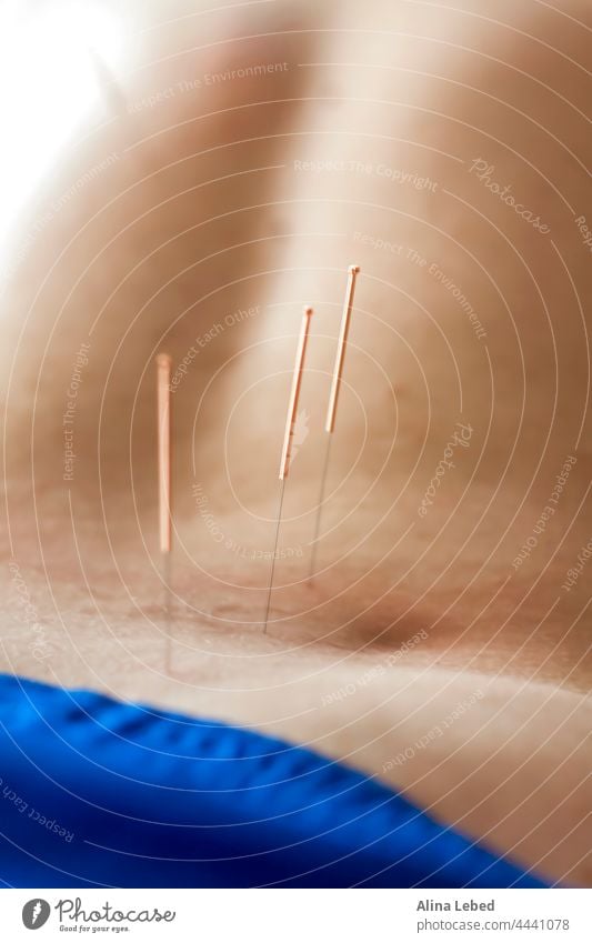 Ein Mann wird mit Akupunktur am Rücken behandelt. Das Akupunkturverfahren. Text Konzept Wort Business Hintergrund reisen Zeichen Symbol weltweit international