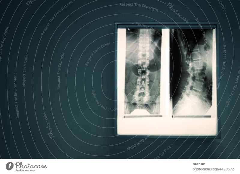 Röntgenbild Wirbelsäule Röntgenaufnahme Radiologie Diagnostik Arzt Gesundheitswesen Skelett Technik & Technologie Klinik Krankheit Knochen medizinisch