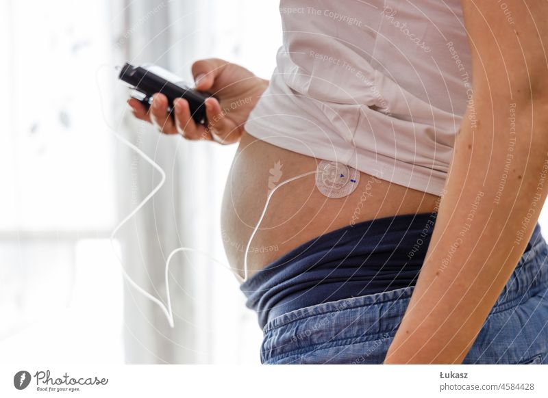 Eine schwangere Frau bedient eine Insulinpumpe. Moderne Diabetes-Behandlung mit Insulin, das über einen im Bauchraum angebrachten Drainageschlauch verabreicht wird.