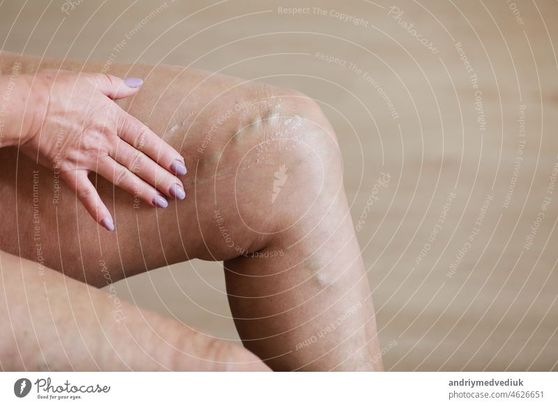 Die Frau reibt ihre müden Beine mit einer speziellen Creme ein, um die Schmerzen zu lindern. Phlebologie. Schmerzhafte Krampfadern und Besenreiser an aktiven Frauenbeinen, Medizin und Gesundheit.