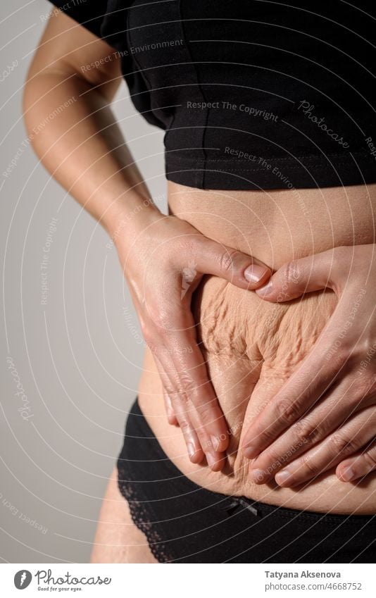 Frau Bauch mit Dehnungsstreifen und Narben Mark Haut Körper Unterleib Magen Körperfreundlichkeit Echter Körper Person Gesundheit Fett Schwangerschaft Striae
