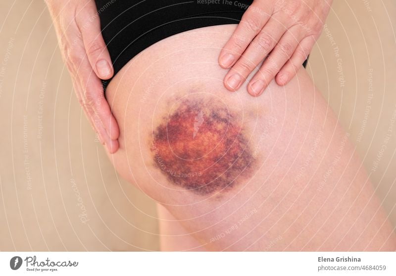 Hämatom am Bein einer Frau in Nahaufnahme. Großer Bluterguss am Bein einer Frau. blaue Flecken Trauma purpur Konzept Gewalt Unfall Gesundheit Verletzung Haut