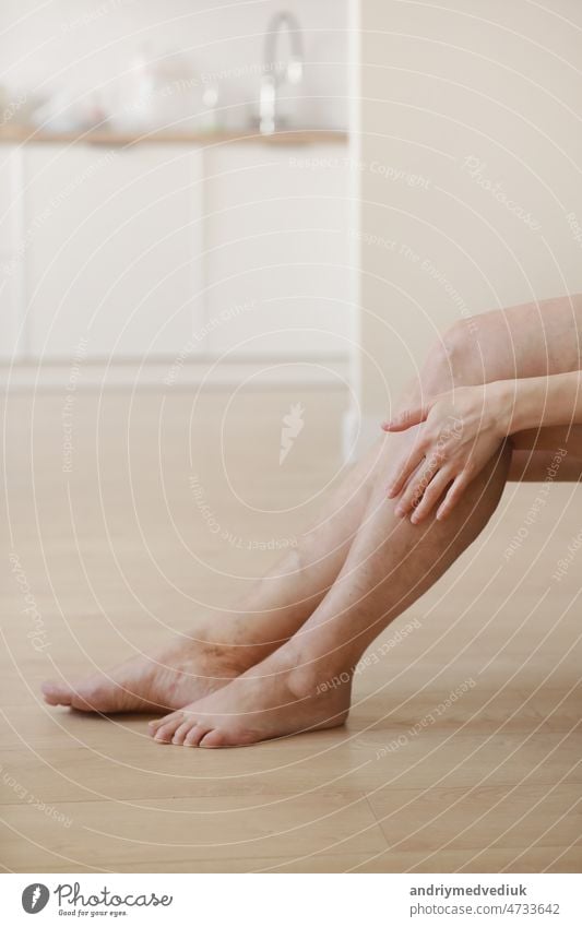 Schmerzhafte Krampfadern und Besenreiser an den Beinen einer aktiven Frau, die sich selbst hilft, die Schmerzen zu überwinden. Gefäßerkrankungen, Krampfadern Probleme, aktives Lebenskonzept.