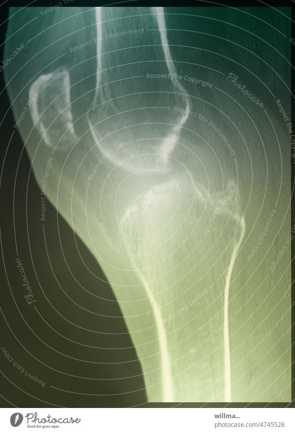 Der Unterschied zwischen Patella und Paella Kniescheibe Kniegelenk Fraktur Verletzung Patellafraktur Bruch CT Computertomographie Diagnostik Röntgendiagnostik