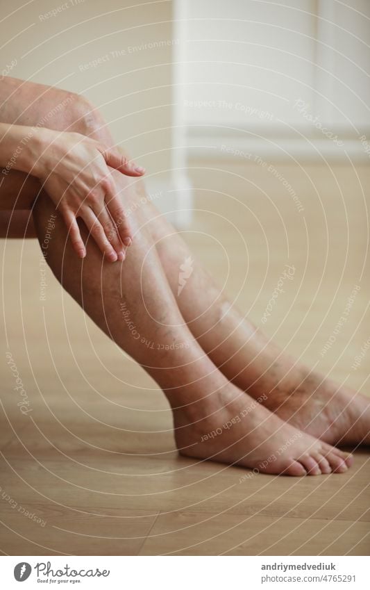 Schmerzhafte Krampfadern und Besenreiser an den Beinen einer aktiven Frau, die sich selbst hilft, die Schmerzen zu überwinden. Gefäßerkrankungen, Krampfadern Probleme, aktives Lebenskonzept.