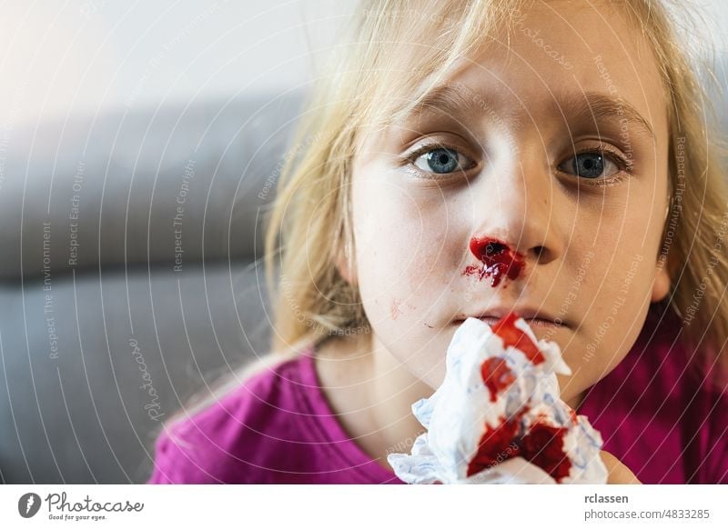 Kind, das versucht, die Blutung aus der Nase zu stoppen. Epistaxis bei einem Kind. Blut aus der Nase Nahaufnahme, Nasenbluten Schmerzen Allergie Anämie