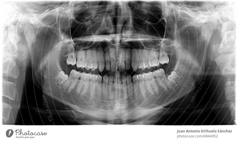 Pantographie der perfekten Zähne eines gesunden jungen Mannes. Röntgenaufnahme eines menschlichen Mundes. Stromabnehmer Abtastung Orthopantomogramm Karies