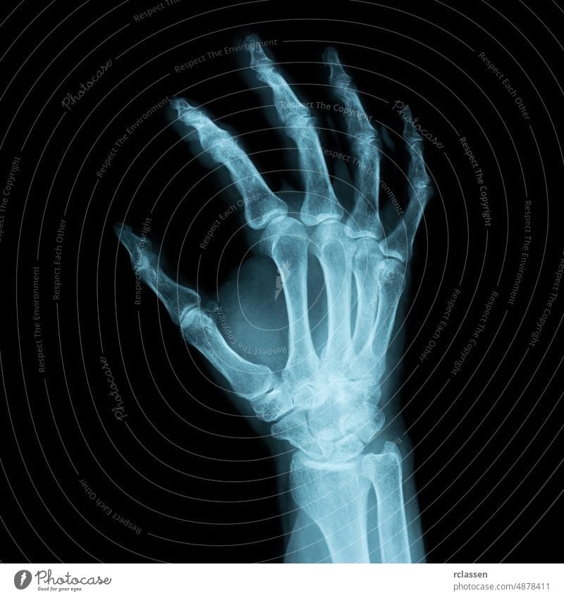 Röntgenbild einer menschlichen rechten Hand für eine medizinische Diagnose x röntgen Zutritt Röntgenaufnahme Anatomie Arzt Medizin Chirurgie Durchsichtigkeit