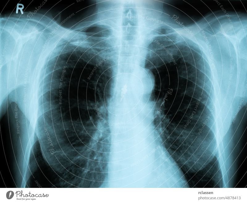 Röntgenbild des menschlichen Brustkorbs x röntgen Zutritt Röntgenaufnahme Anatomie Arzt Medizin Chirurgie medizinisch Durchsichtigkeit Körper Krankenhaus Rochen