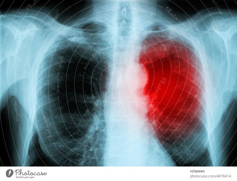 Röntgenrotes Herz des Menschen (Herzkrankheit) Schmerz menschlich gruselig Rauchen medizinisch Prüfung ungesund Strahlung Zutritt Skelett Rochen Krankheit