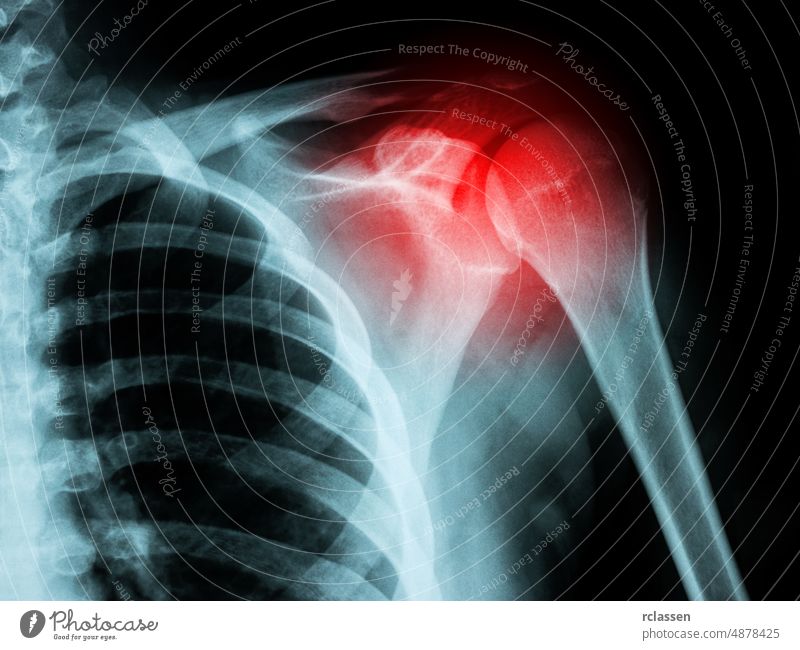 Röntgenbild einer Schulterfraktur Schmerz menschlich sich[Akk] bewegen gruselig medizinisch Prüfung ungesund Strahlung Zutritt Pause Skelett männlich Rochen