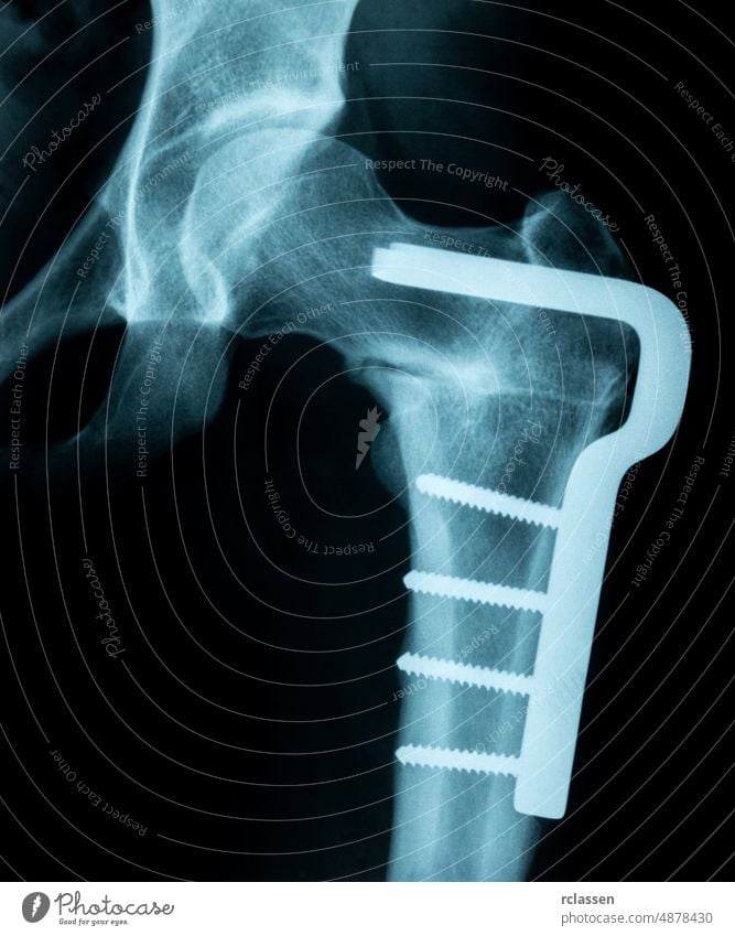 Röntgenbild eines gebrochenen Beckens/Hüfte mit Metallstiften, die es zusammenhalten x röntgen Zutritt Röntgenaufnahme Anatomie Arzt Medizin Chirurgie