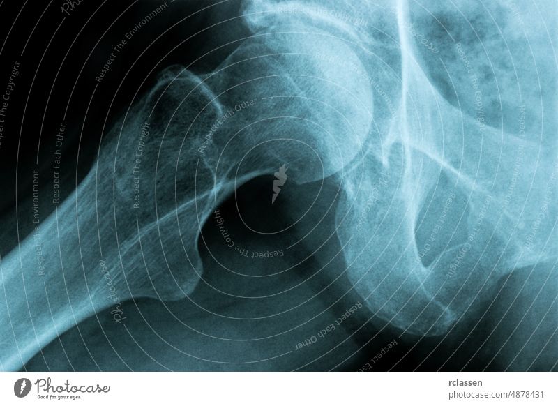 Röntgenbild eines Hüftgelenkknochens der menschlichen Brust x röntgen Zutritt Röntgenaufnahme Anatomie Arzt Medizin Chirurgie medizinisch Durchsichtigkeit