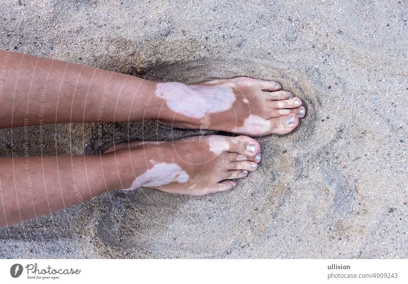 Beine und Füße einer Frau mit Vitiligo-Pigmentfleckenkrankheit im Sand, Kopierraum Fuß Fleck Krankheit Strand Textfreiraum farbig Erkrankung melanin Dermatitis