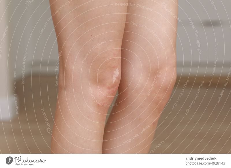 Hautallergien, Beine Haut Frauen. Nahaufnahme von roten Pusteln auf einem Knie, eine allergische Reaktion, die durch atopische Dermatitis verursacht wird. Ausgewählter Fokus