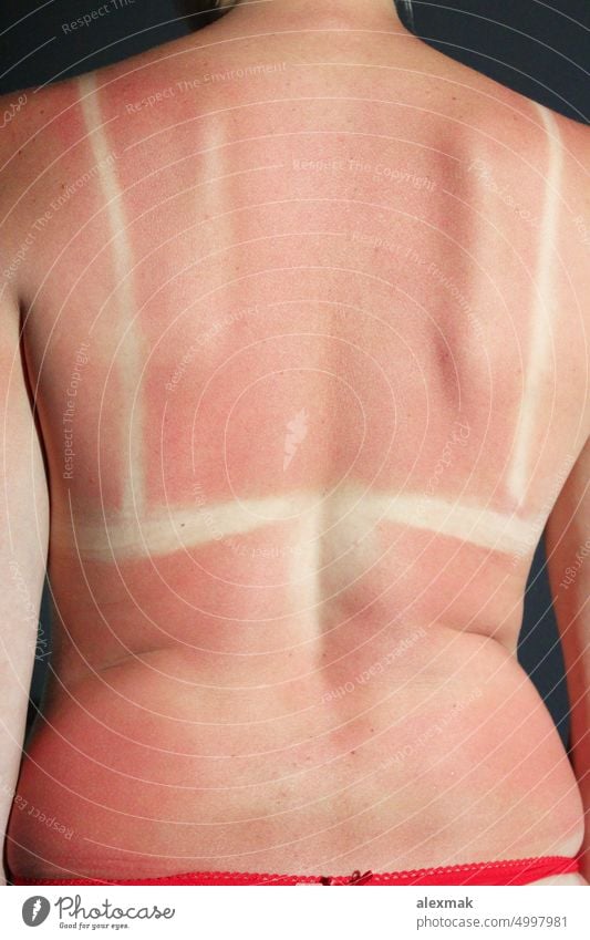 Verbrannter Rücken nach Sonnenbrand verbrühen Körper Brandwunde verbrannt Haut rot rosa Krebs Sommer Allergie krebsartig Pflege Kaukasier Schaden gefährlich