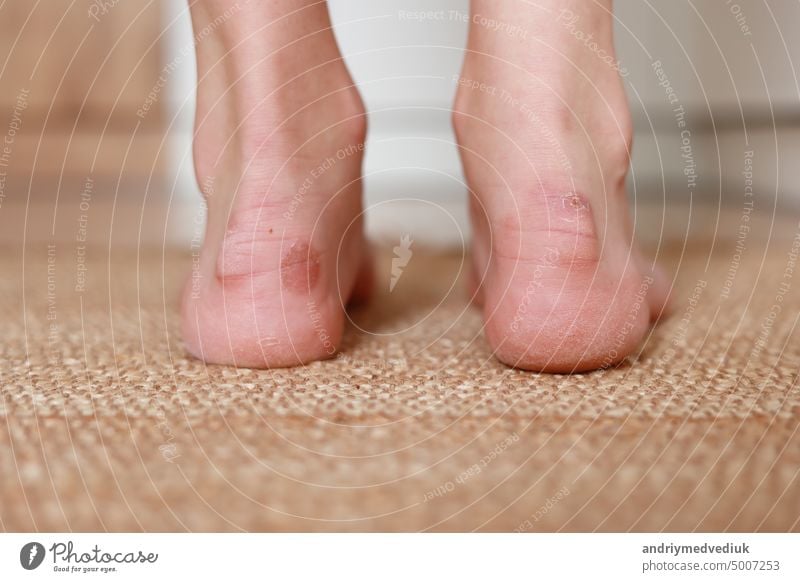 Schwielenblasen an Frauenfüßen. Schmerzhafte Wunden. Unbequeme Schuhe Probleme. Blick auf Fuß mit entzündlichen Hühneraugen. Gesundheit und Schönheit Konzept.