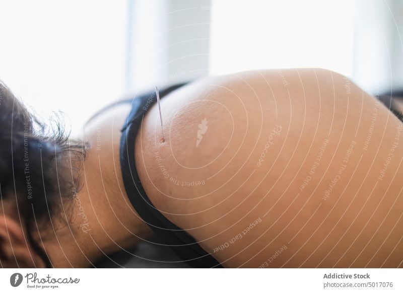 Frau erhält Akupunkturbehandlung im Salon Therapie Nadel alternativ geduldig Verfahren Leckerbissen Rehabilitation Massage Schulter Medizin Therapeut