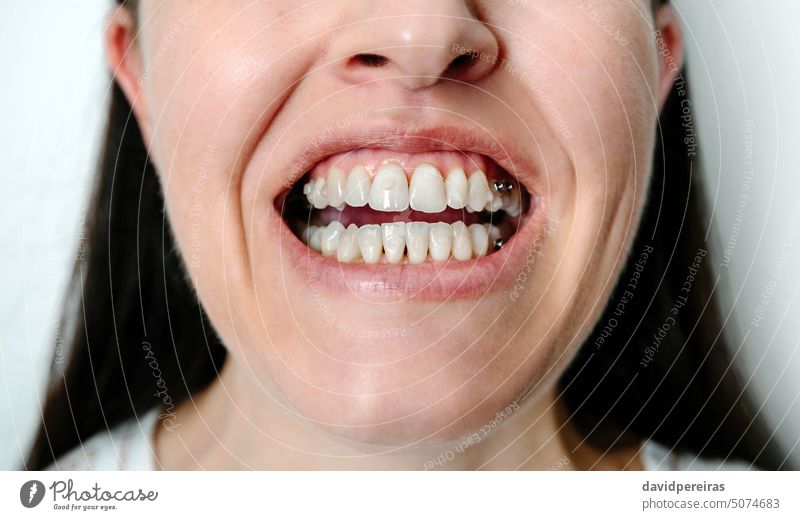 Frau mit offenem Mund, der Aufsätze und Zahnknöpfe für eine kieferorthopädische Behandlung zeigt unkenntlich dental Zähne Zusammenhalt Schaltfläche Aufbissrampe