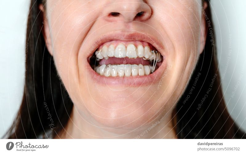 Frau mit offenem Mund in kieferorthopädischer Behandlung mit transparenten herausnehmbaren Alignern unkenntlich dental Vorschuss Abnehmbar unsichtbar