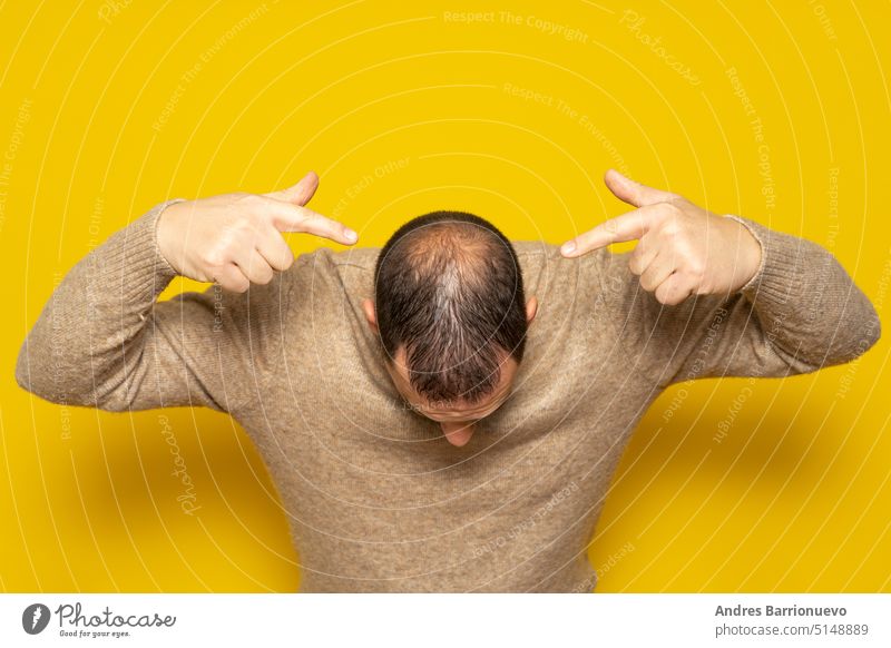 Alopezie oder Haarausfall beim Menschen. Latino-Mann mittleren Alters, der auf seinen Kopf zeigt und seine beginnende Alopezie hervorhebt Verlust Rückseite