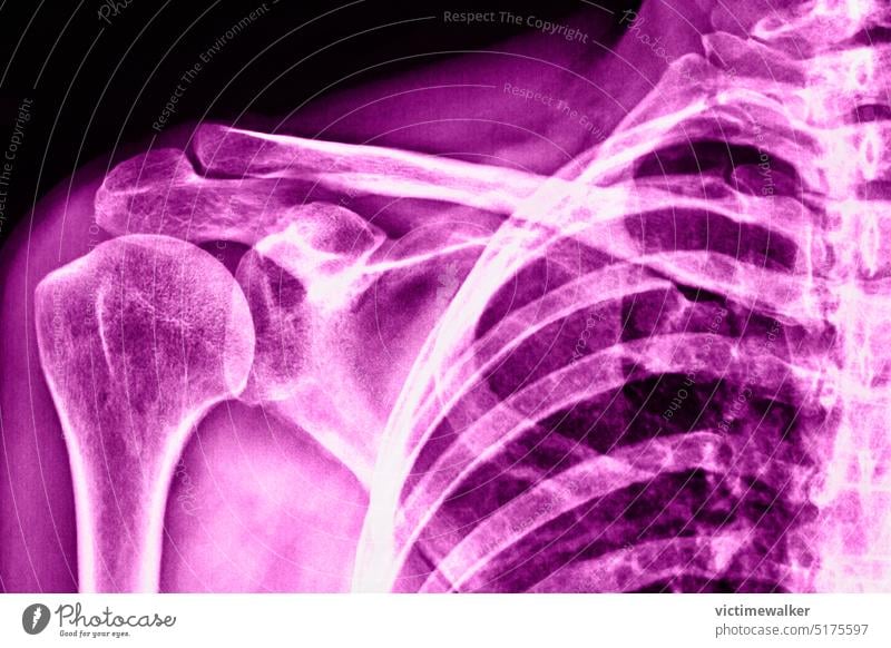 Nahaufnahme einer Röntgenaufnahme der Schulter röntgen medizinisch Knochen Rosa Farbe Gesundheit Hintergrund Gesundheitswesen Anatomie menschlicher Körperteil