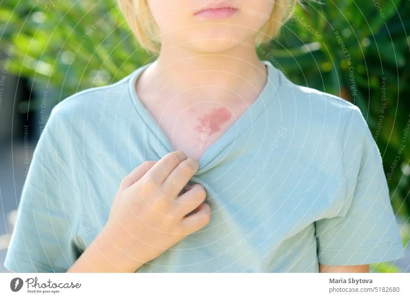 Zeichen auf der Haut der Brust eines achtjährigen Kindes. Ein Hämangiom ist ein rotes Muttermal aus Blutgefäßen auf der Haut, ein gutartiger Tumor. Junge Mark