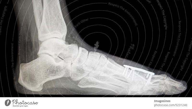 Röntgenbild der Knochenspan -Distraktionsarthrodese - MTP1 des Großzehengrundgelenks nach Resektionsarthroplastik. Eingefügter Knochenspan mit Platte. weiblicher Fuß nach der Operation - Stehposition mit minimaler Belastung, Druck