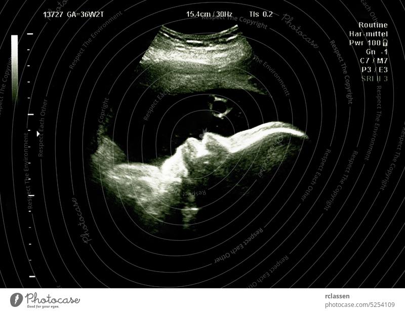 Winziges Baby dreht sich im Bauch der Mutter während des Ultraschallverfahrens und macht eine Blase Scan Sonogramm Fötus Gebärmutter Schwangerschaft schwanger