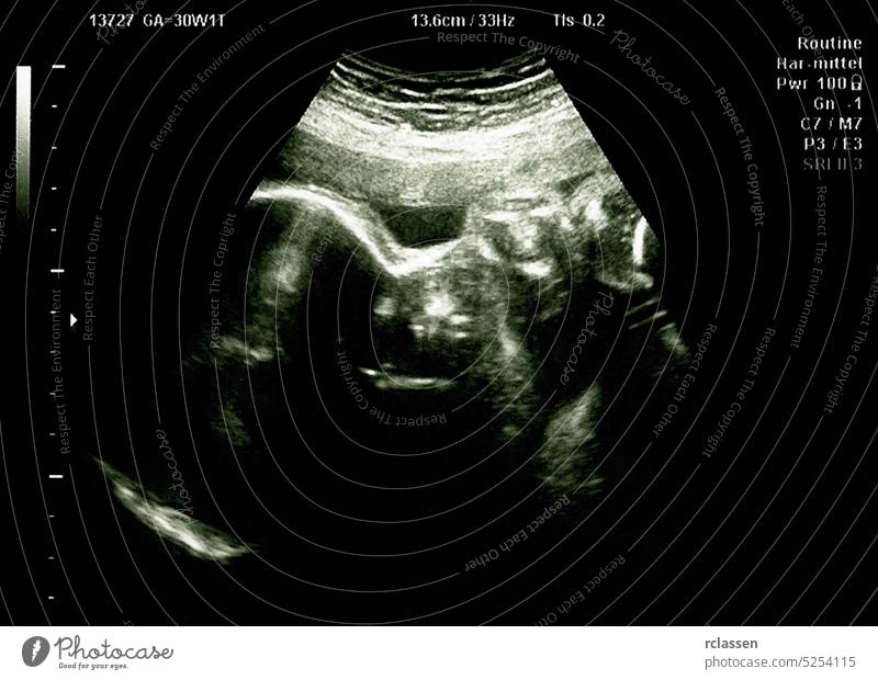 Ultraschallbild des Babys im Mutterleib. Echographie-Scan. Sonogramm Fötus Gebärmutter Schwangerschaft schwanger Sonar Ultraschalluntersuchung ungeboren ultra