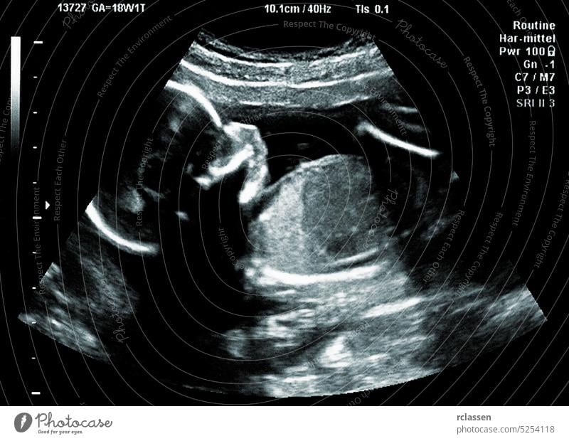 Ultraschallbild eines Babys im Mutterleib Scan Sonogramm Fötus Gebärmutter Schwangerschaft schwanger Sonar Ultraschalluntersuchung ungeboren ultra Frau Klang 3d