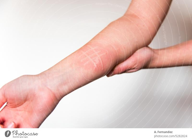 Detailaufnahme des Arms einer Person, die von der Hautkrankheit Dermographismus betroffen ist. Hauterkrankung namens Dermatographismus oder atopische Dermatitis