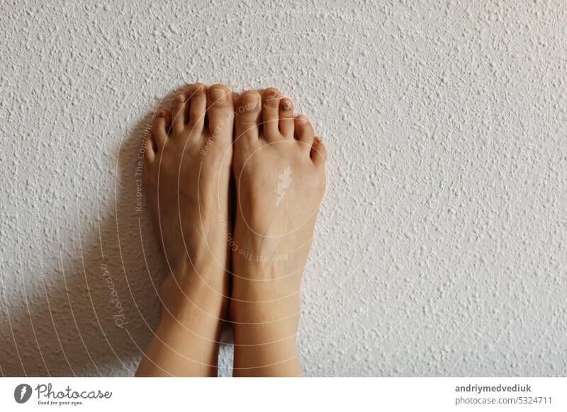 Weibliche Füße mit subungualem Hämatom, schwarze Zehennägel, verursacht durch Trauma, Pilzinfektion, Chemotherapie. Person mit Onychomykose, einer Pilzinfektion, die eine Gelbfärbung des Zehennagels verursacht. Kopierraum