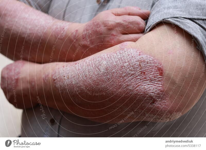 Psoriasis-Haut mit roten Wunden. Männliche Arme mit rissiger, harter, verhornter, schuppiger Haut. Dermatologische Probleme mit Allergie, Ekzem. Flecken an den Händen, Hautausschlag, trockene Haut. Das Konzept der Behandlung chronischer Krankheiten