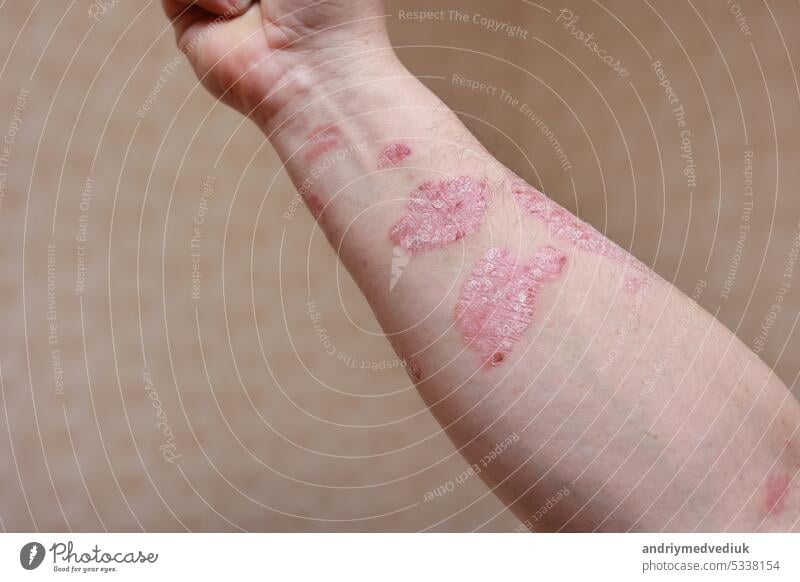 Mann mit krankem Arm, trockener schuppiger Haut an der Hand mit vulgären Psoriasis-Wunden, Allergie, Ekzem und anderen Hautkrankheiten wie Pilz, Plaque, Ausschlag und Unreinheiten. Genetische Autoimmunerkrankung.