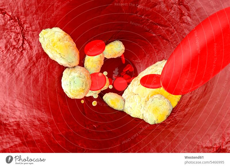 3D gerenderte Illustration, Visualisierung von Fett, das eine Arterie verstopft und die Krankheit Arteriosklerose bildet Pulsadern Menschliche Arterien