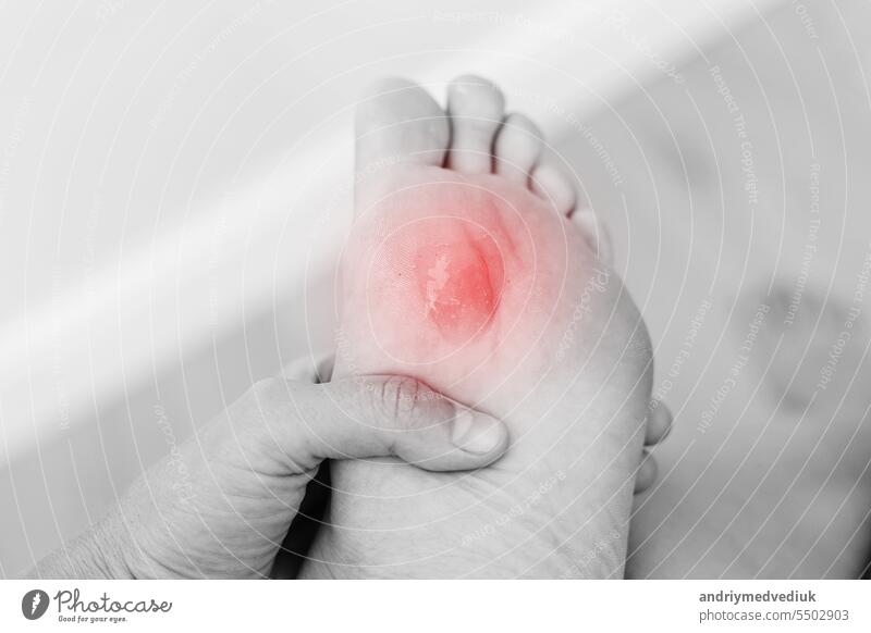 Close up Schwarz-Weiß-Foto von Frau Fußsohle mit schmerzhaften Kallus mit roten Punkt. Frau leidet unter Schmerzen aufgrund von Hühneraugen am Bein. Das Problem ist auf enge Schuhe zurückzuführen. Gesundheitswesen und Medizin Konzept