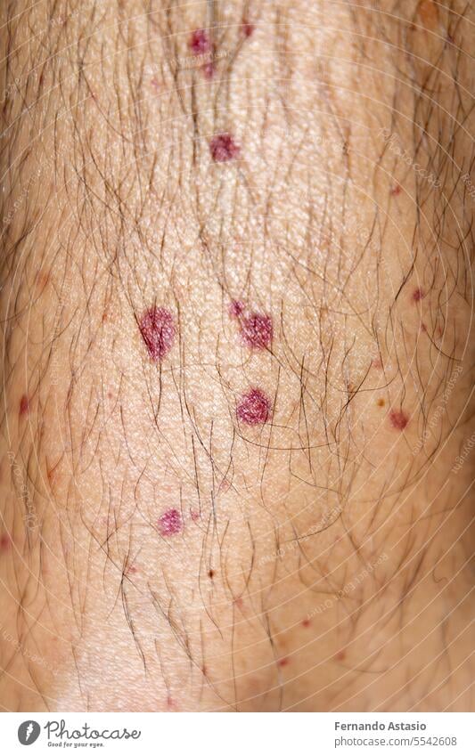 Vaskulitis. Vaskulitis in den Beinen. Kleine rote oder violette Flecken. Post-Covid-Syndrom aufgrund einer immunologischen Reaktion des Körpers. Körner. Entzündung der Blutgefäße. Seltene Krankheit. Fotografie.