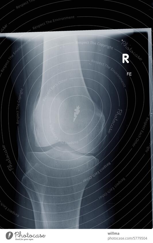 Röntgenbild nach einer Kniescheiben-Fraktur Gelenk Kniegelenk Patella Verletzung Patellafraktur Bruch Röntgendiagnostik Diagnostik Knochen Röntgenaufnahme