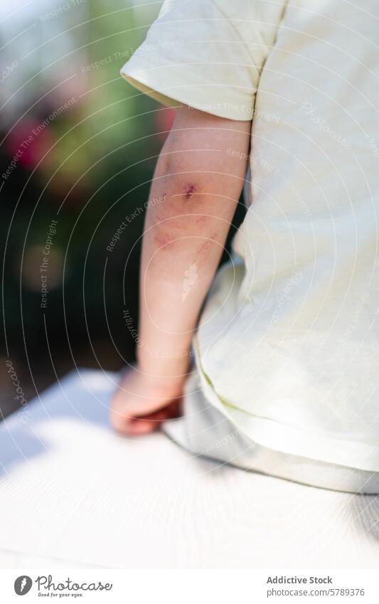 Nahaufnahme des aufgeschürften Ellbogens eines Kindes im sonnenbeschienenen Garten geschabt blaue Flecken minderjährig Verletzung im Freien spielen Unfall
