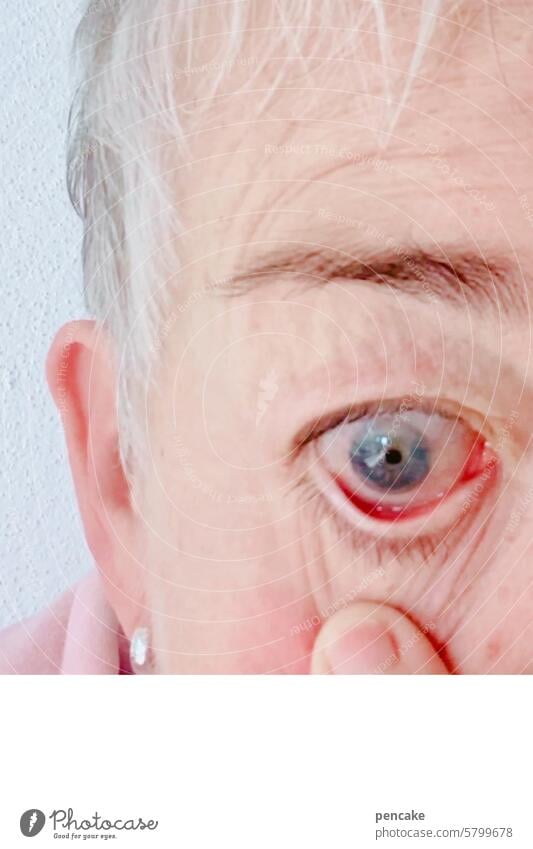 zähne zsmmnbßn | bakterielle konjunktivitis Auge Entzündung Konjunktivitis krank Bakterien Nahaufnahme Detailaufnahme rot gerötet Bindehautentzündung Infektion