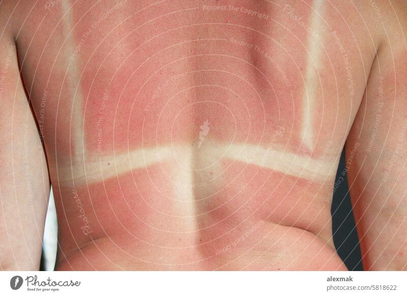 Verbrannter Rücken nach Sonnenbrand verbrühen Körper Brandwunde verbrannt Haut rot rosa Krebs Sommer Allergie krebsartig Pflege Kaukasier Schaden gefährlich