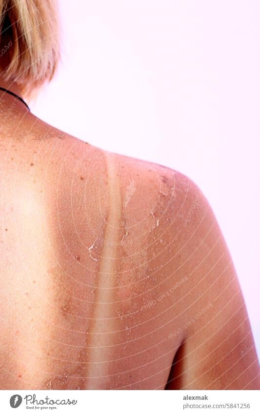 Verbrannter Rücken nach Sonnenbrand verbrühen Körper Brandwunde verbrannt Haut rot rosa Krebs Spur Sommer Allergie krebsartig Pflege Kaukasier Schaden