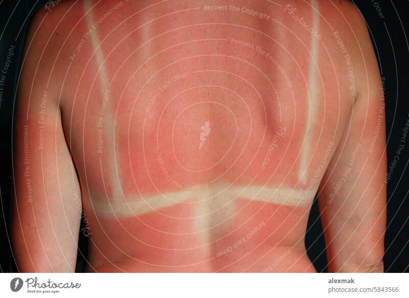 Verbrennungen durch die Sonne auf dem Körper Sonnenbrand Haut rot rosa Krebs Sommer Allergie Rücken Brandwunde verbrannt krebsartig Pflege Kaukasier Schaden